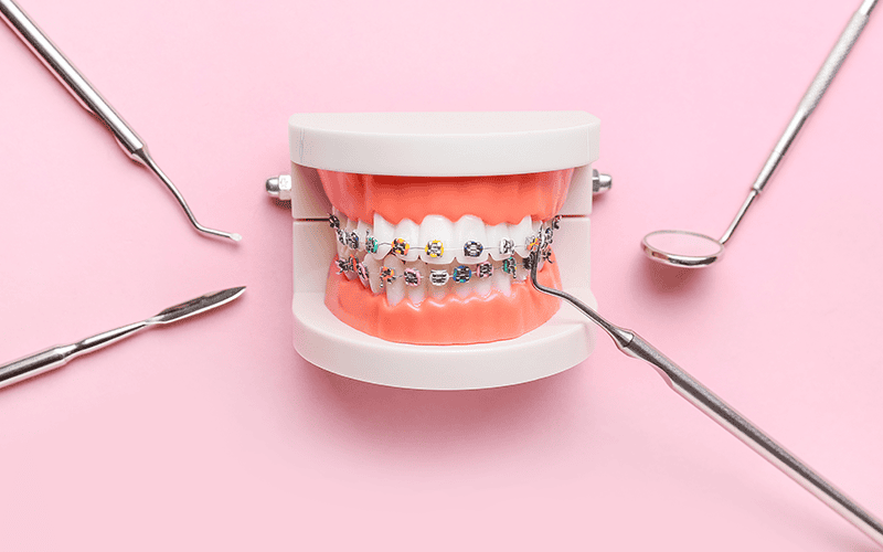Braces on a model of a mouth
