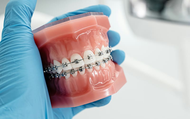 3D representation of a mouth with braces