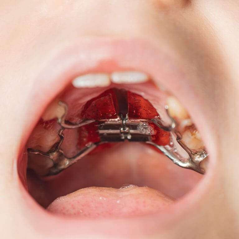 A palatal expander appliance in a child's mouth