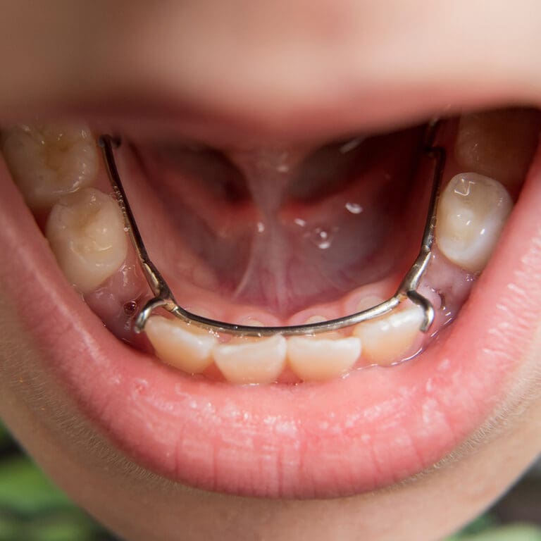 A space maintainer appliance on the bottom row of a child's teeth
