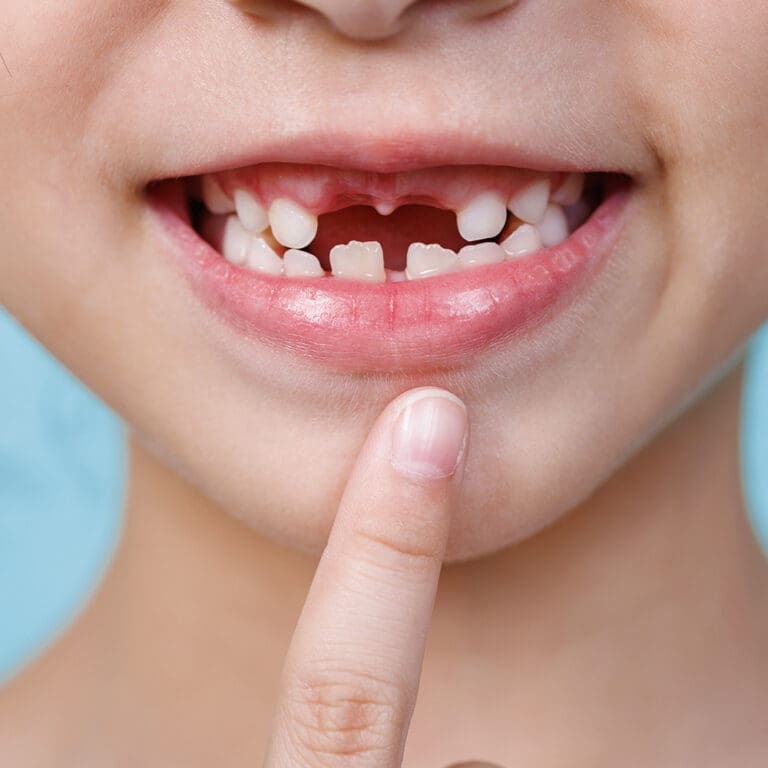 Young girl pointing to her missing teeth